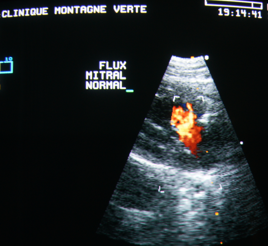 Echographie cardiaque