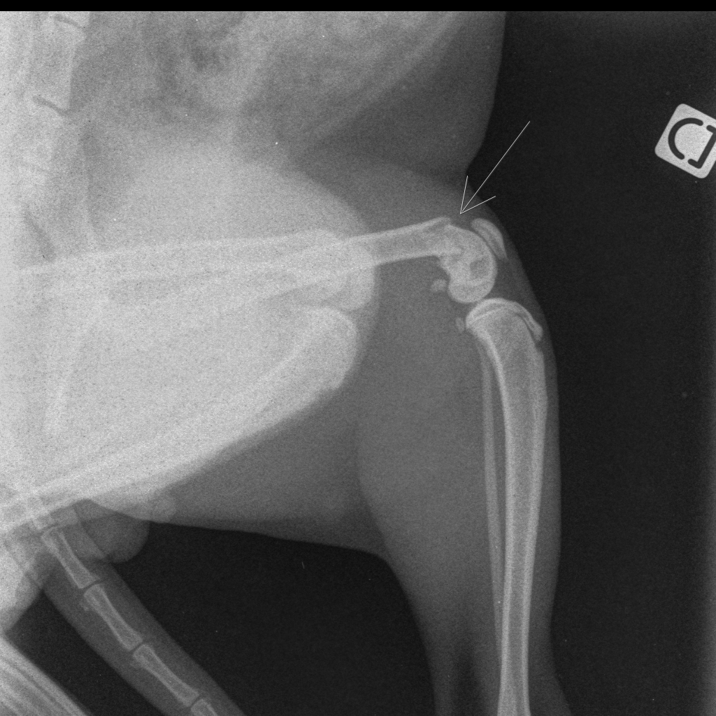 Fracture epiphyse distale Femur

